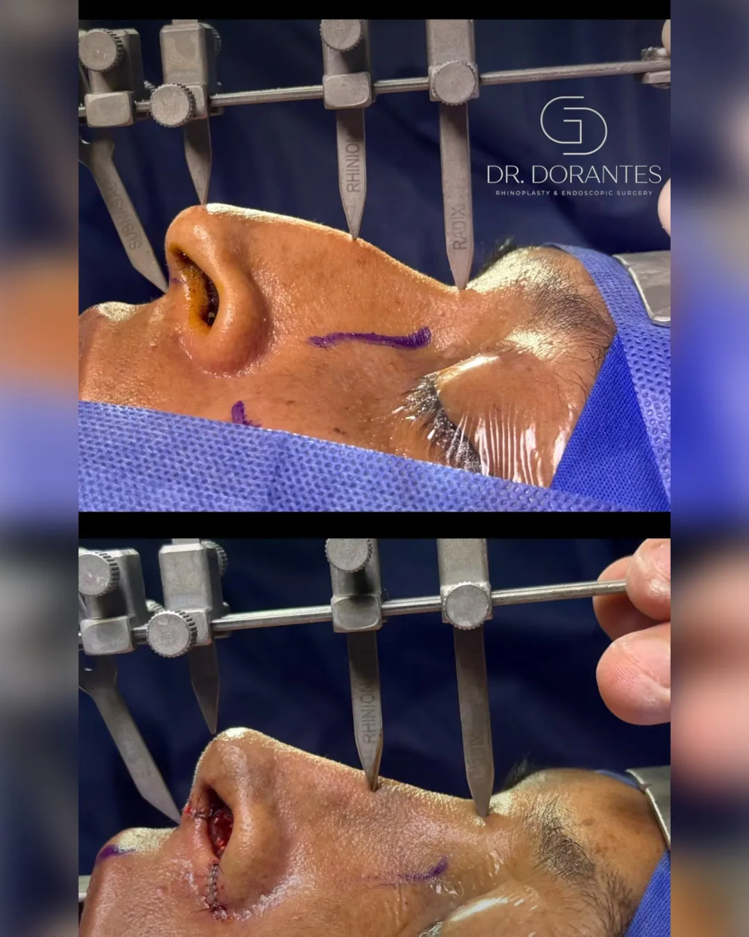 Reel — Rinoplastia