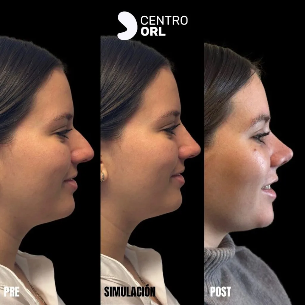 Rinoplastia funcional y estética en CDMX — Cirugía de nariz